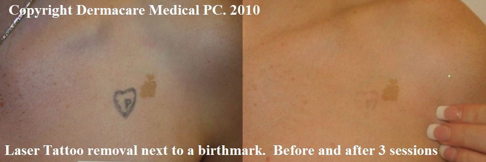 Chest tattoo removal Unless tattoo ink is very deep in the skin 