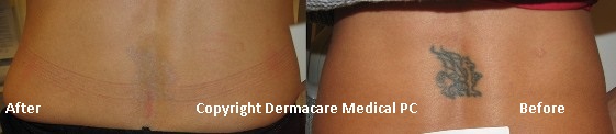 back tattoo before and after laser tatttoo removal