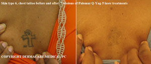 chest tattoo before and after laser removal