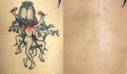 laser tattoo removal before and after